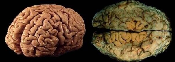 ο εγκέφαλος ενός υγιούς και πόσιμου ατόμου